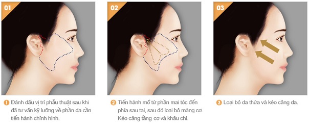 Phẫu thuật căng da mặt - Thẩm mỹ viện Nguyễn Thế Thạnh
